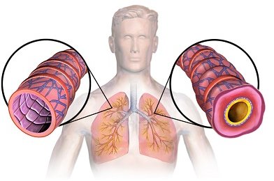 Normal vs Inflamed Air Passage