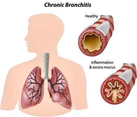 Normal vs Inflamed Air Passage