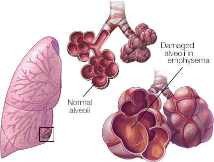 Normal vs Damaged Alveoli in Emphysema