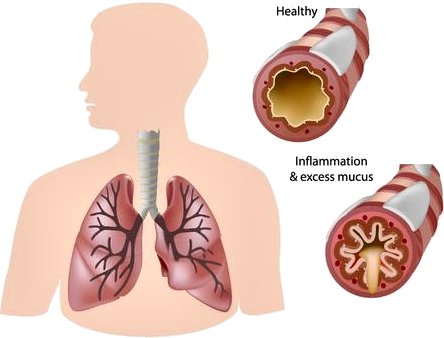 Speleotherapy and respiratory health